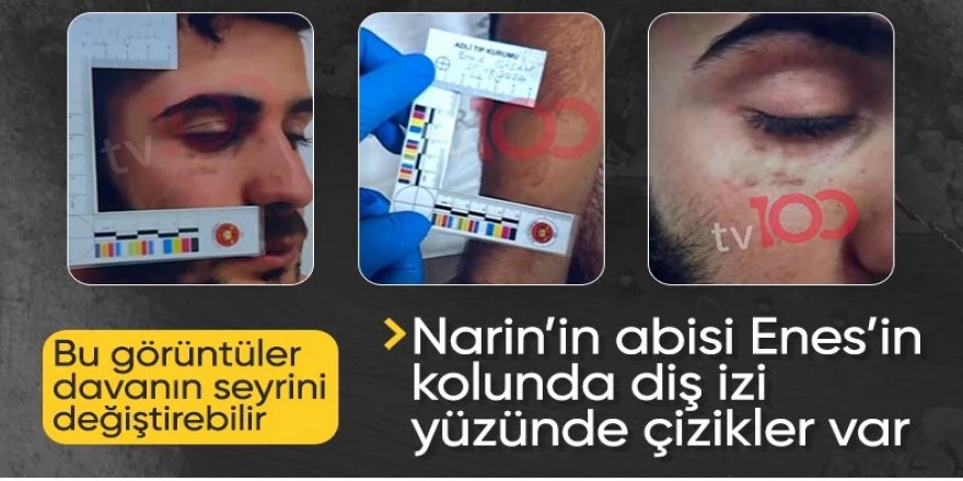 Ağabey Enes Güran'ın yüzündeki morluk ve ısırık izleri...