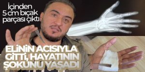 Elinin acısıyla gittiği hastanede çekilen röntgenle hayatının şokunu yaşadı